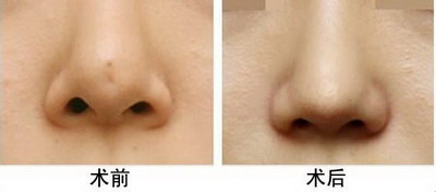 怎么使鼻孔变大_把鼻孔缩小的方法