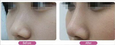 做鼻中隔软骨延长鼻小柱的优点和适宜人去是哪些？