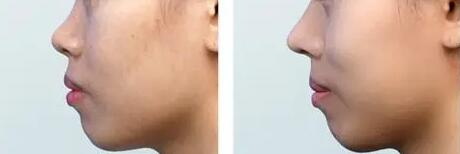 如何养成高鼻梁方法