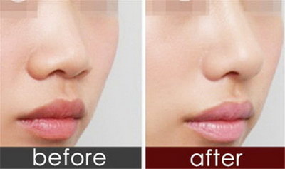 鼻子整容前后，如何才能恢复的更快呢？
