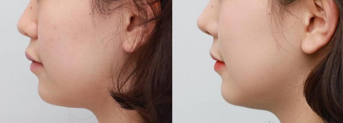 鼻子做线雕能保持多久(什么是线雕隆鼻？)