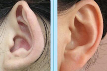 耳朵先天性闭锁畸形怎么治疗_耳朵先天性闭锁是会遗传吗