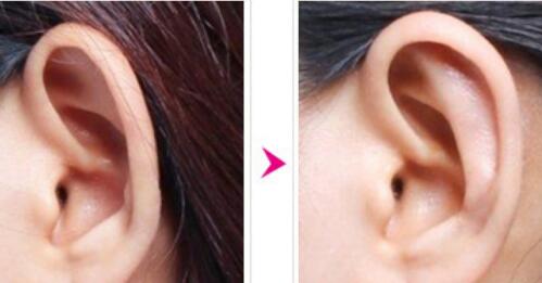 再造耳廓，帮助改变人生_访问一个耳廓再造手术患者
