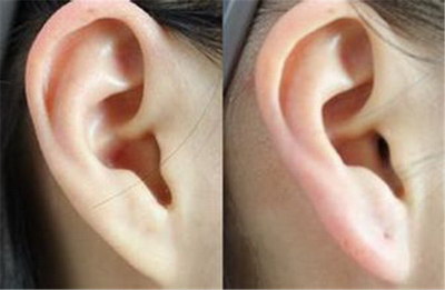 耳垂缝针――一种有效的修复耳垂病变的手术_耳垂疤痕疙瘩能治愈吗