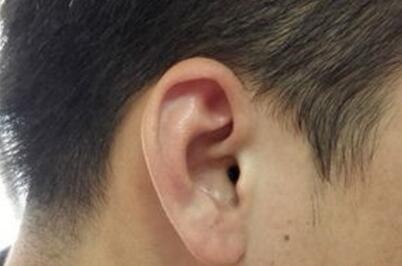 全耳再造手术一般使用什么方法
