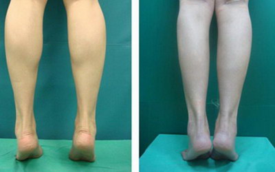 5种有效的O型腿矫正方法