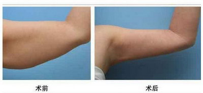 手臂肌肉劳损多久才能恢复_手臂抽脂一个月后还会瘦吗?