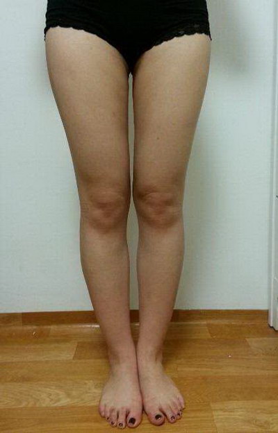 大腿环吸多久是消肿期_大腿环吸多久消肿