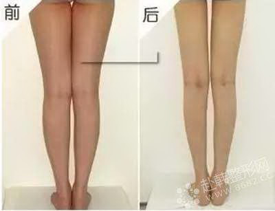 小腿抽脂的副作用及如何解决_小腿抽脂:一种有效的减肥方式