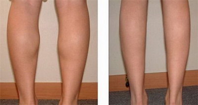 大腿内侧皮肤粗糙是什么原因(大腿内侧皮肤粗糙是怎么回事)