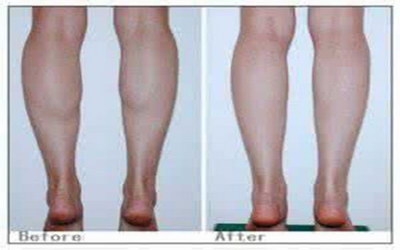 如何有效减少大腿内侧赘肉?_大腿内侧抽脂手术后可以多久进行同房?