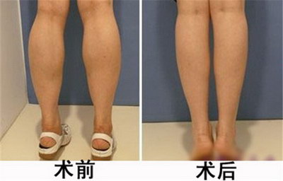 最有效的瘦臀瘦大腿简单动作_怎么样可以快速的瘦大腿