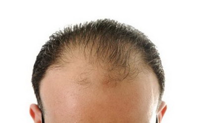 头发少容易掉怎么办？专家教你如何预防脱发