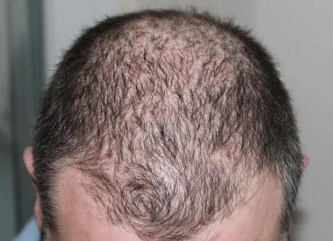 头顶和前额脱发就是脂溢性脱发_治疗脂溢性脱发的药物有副作用吗