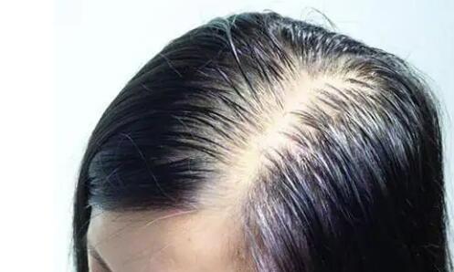 油脂性脱发因为什么_油脂性脱发是什么