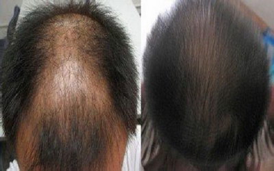 昆明哪有治疗脱发的_更年期会大量脱发吗