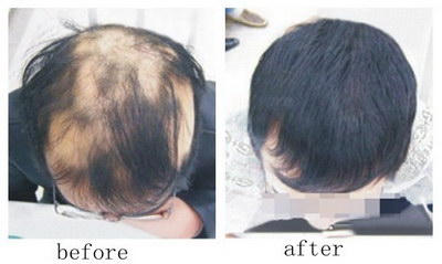 脂溢性脱发怎么治疗最有效_脂溢性脱发是什么意思