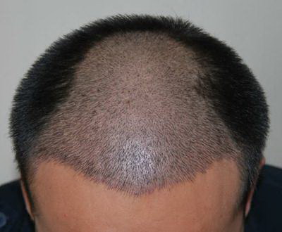 雄激素性脱发什么意思_红光治疗仪可以治疗脱发吗