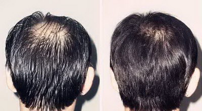 雄性激素脱发最佳治疗方案_乌鸡白凤丸对脱发有效果吗