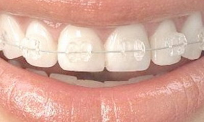 拔牙后五天牙龈肿痛治疗方法(拔牙后五天牙龈肿痛正常吗)