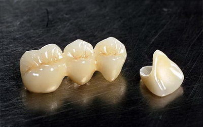 活动义齿,固定义齿种植牙哪个好(活动义齿和固定式种植牙的优劣分析)