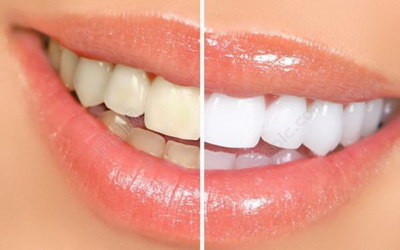 有一颗牙齿不整齐可以做牙冠