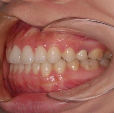 牙齿纤维瘤手术后注意事项_牙齿纤维瘤可以治疗吗