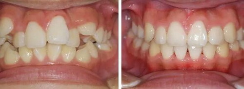 拔牙可以医保报销么_月经过几天可以拔牙