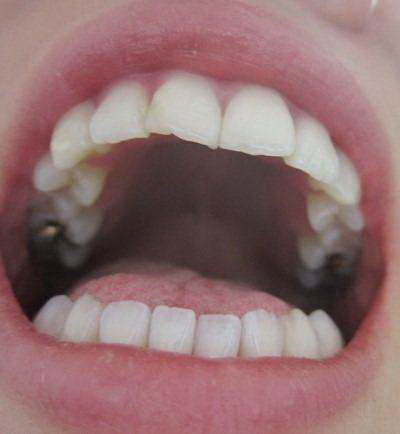 牙齿贴面能洗牙吗