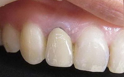 种植牙修复什么意思需要多久