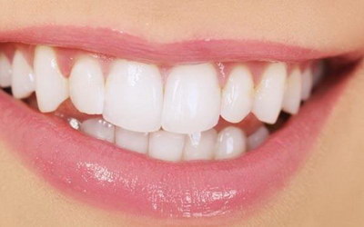 什么是反颌牙_什么是反颌牙