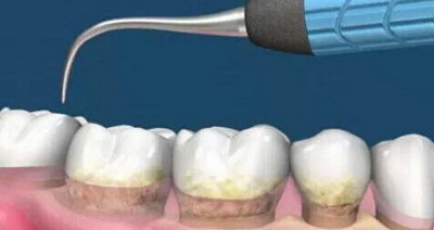 牙龈增生切除后创面怎么处理