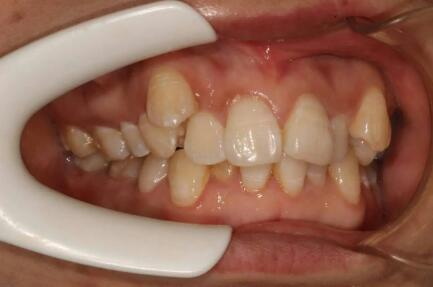 智齿一般多大年龄长的_智齿会挤压牙齿导致牙齿变得拥挤吗