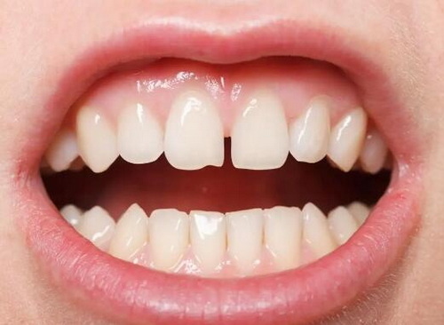 拔牙之后凝血块多久消失正常_拔牙之后旁边的牙齿松了正常吗