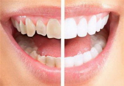 牙套矫正牙齿费用要多久呢？