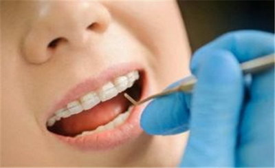 戴牙套会导致牙齿裂纹吗