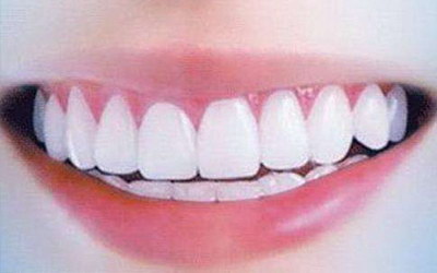 楔状缺损的好发牙位_牙周刮治器及牙位