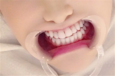 温州牙齿多久矫正_牙齿黄的能洗白吗