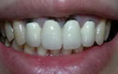 牙齿上有很多小洞_牙齿矫正进口自锁