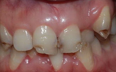 做完根管治疗第一步后牙齿疼的不能碰(为什么做完根管治疗第一步后牙齿会疼，不能碰)
