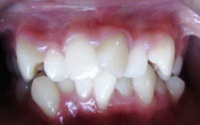 天包地牙齿矫正后嘴唇的变化【天包地牙齿矫正后图片】
