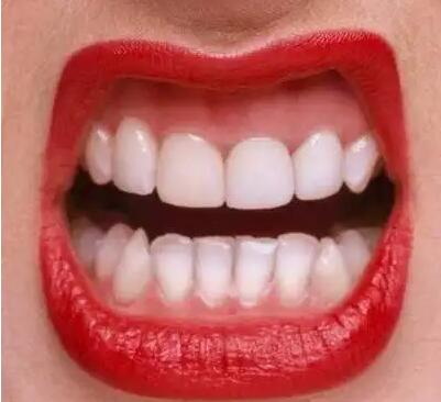 成人牙齿矫正有什么方法