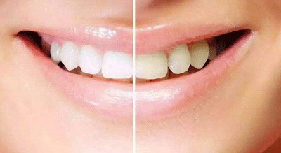 拔牙后多久种植牙比较好(什么是种植牙？)