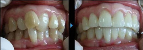 种植牙一般用几年_种植牙有什么副作用吗