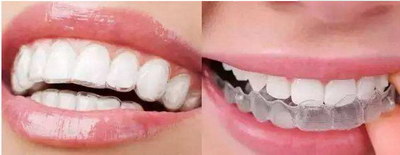 磁伸缩洗牙的缺点_冷光美白前洗牙重要性