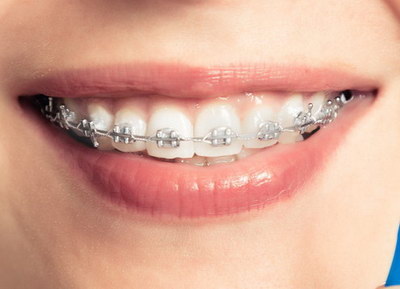 牙齿矫正牙龈肿胀为什么