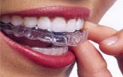 牙齿缝里面黑色的是什么(牙齿里面黑色的东西是什么)