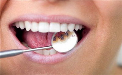 每个牙齿有几个根管_温州根管治疗方法