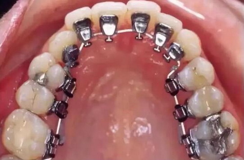 牙周炎牙齿松动可以固定吗