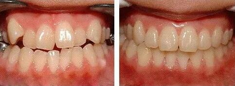 婴儿前门牙牙齿有白斑可以涂氟吗